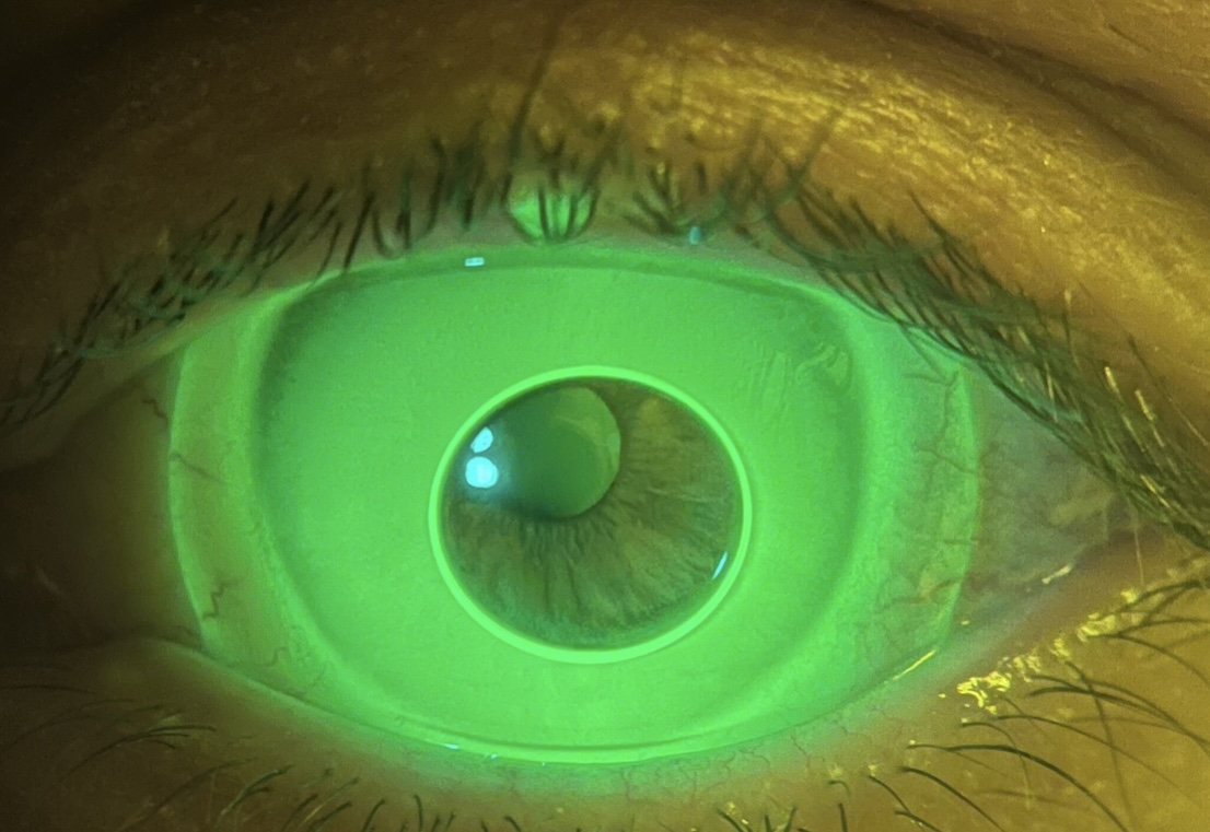 L'oeuf au plat @Leslie Bosveil